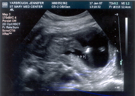 Ultrasound picture with arrow pointing at fetus penis