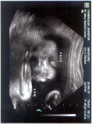 Ultrasound picture